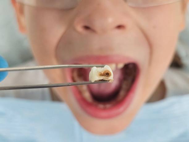 Best Emergency Dentist for Knocked-Out Tooth in Earlimart, CA